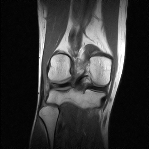 MRI - right knee - top down view
