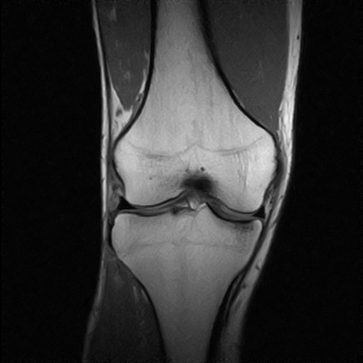MRI - right knee - top down
