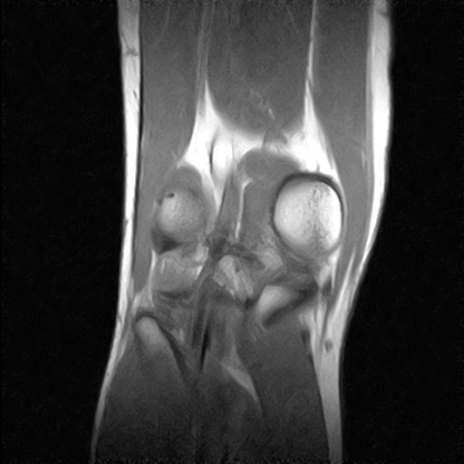 MRI - right knee - top down - animated